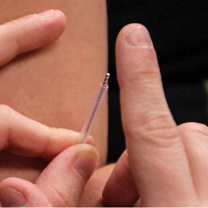 Acupuncture