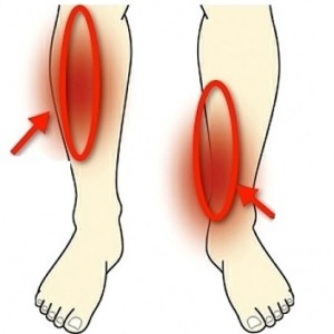shin splints
