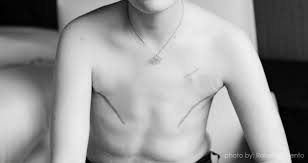 breast cancer